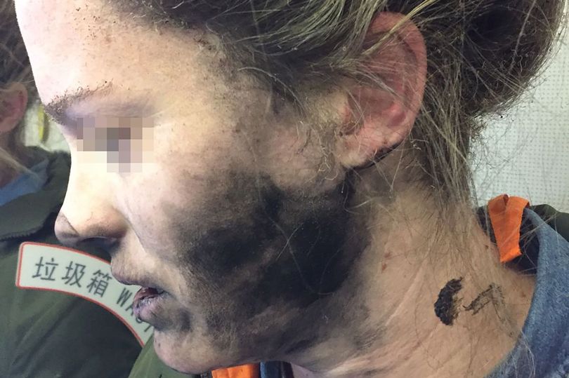 Injures suffered after a headphone exploded mid-flight